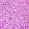 16B1 Ependymoma, anaplastic (Case 16) H&E 7.jpg