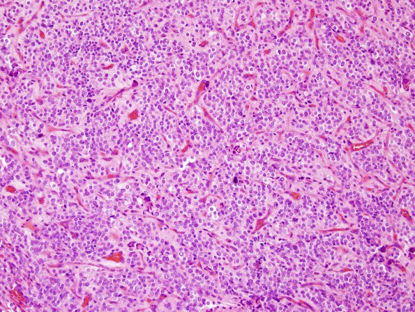 16B1 Ependymoma, anaplastic (Case 16) H&E 7.jpg