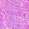 16B2 Ependymoma, anaplastic (Case 16) H&E 4.jpg