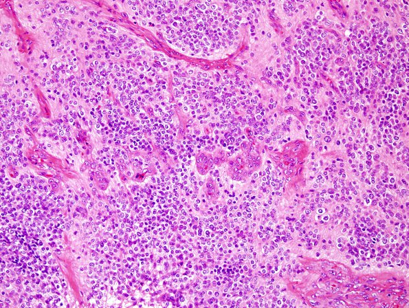 16B2 Ependymoma, anaplastic (Case 16) H&E 4.jpg