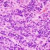 16B3 Ependymoma, anaplastic (Case 16) H&E 5.jpg