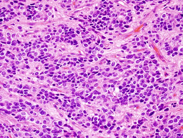 16B3 Ependymoma, anaplastic (Case 16) H&E 5.jpg