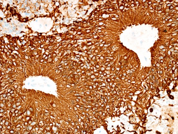 16C Ependymoma, anaplastic (Case 16) GFAP 2.jpg