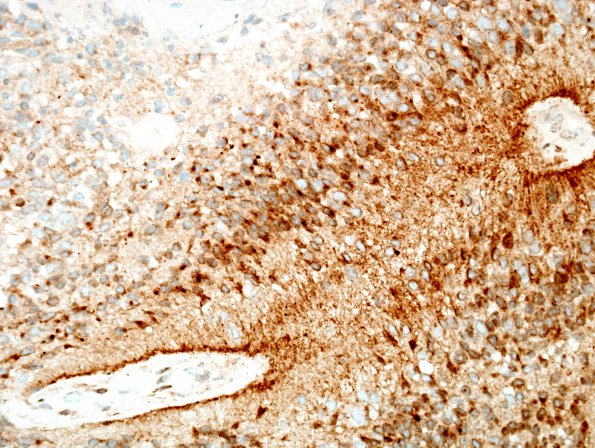 16D Ependymoma, anaplastic (Case 16) D2-40 1.jpg