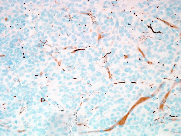 16E Ependymoma, anaplastic (Case 16) NF 1.jpg