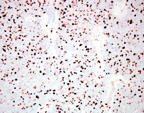 17C Ependymoma, anaplastic (Case 17) Ki67 1