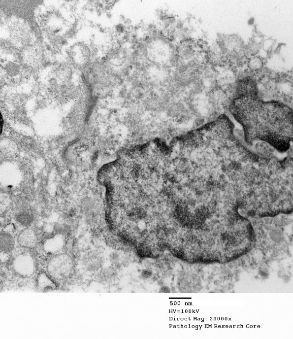 17D (Case 17) Tumor_014 - Copy