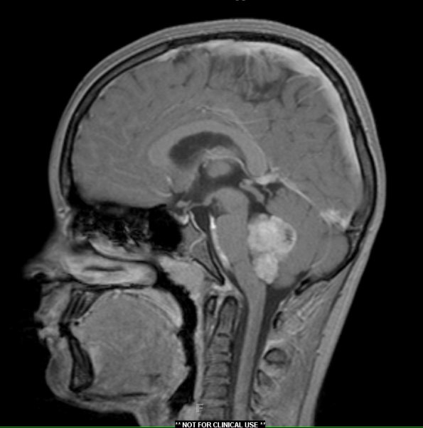 18A Ependymoma, anaplastic WHO III (Case 18) T1W