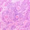 18B1 Ependymoma, anaplastic (Case 18) H&E 1