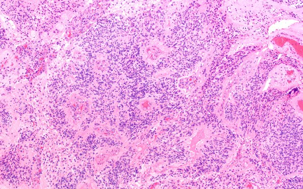 18B1 Ependymoma, anaplastic (Case 18) H&E 1