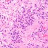 18B2 Ependymoma, anaplastic (Case 18) H&E 2