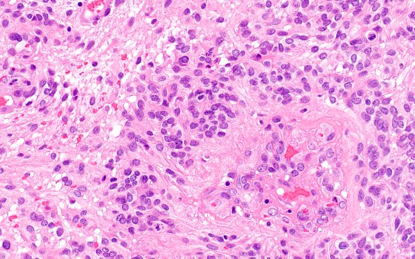 18B2 Ependymoma, anaplastic (Case 18) H&E 2