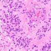 18B3 Ependymoma, anaplastic (Case 18) H&E 3