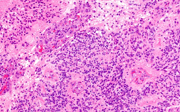 18B4 Ependymoma, anaplastic (Case 18) H&E 4