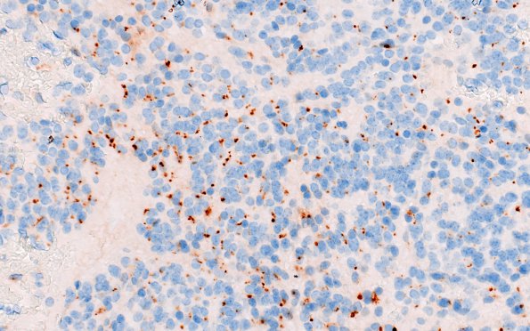 18D1 Ependymoma, anaplastic (Case 18) EMA 40X