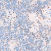 18D2 Ependymoma, anaplastic, WHO III (Case 18) D2-40 1