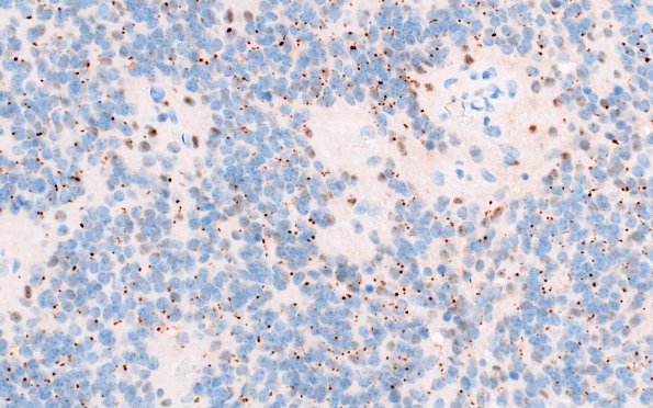 18D2 Ependymoma, anaplastic, WHO III (Case 18) D2-40 1