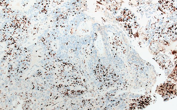 18E Ependymoma, anaplastic (Case 18) Ki67 1