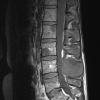 19A1 Ependymoma, anaplastic, metastatic WHO III (Case 19) T1 - Copy - Copy - Copy