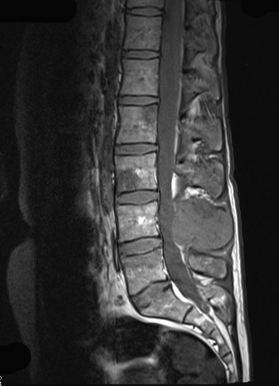 19A1 Ependymoma, anaplastic, metastatic WHO III (Case 19) T1 - Copy - Copy - Copy