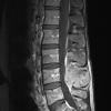 19A2 Ependymoma, anaplastic, metastatic WHO III (Case 19) T1 W - Copy - Copy - Copy