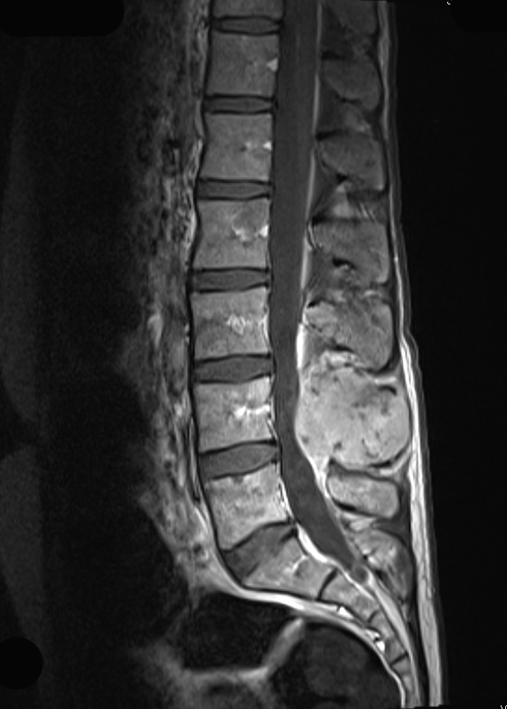 19A2 Ependymoma, anaplastic, metastatic WHO III (Case 19) T1 W - Copy - Copy - Copy