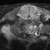 19A3 Ependymoma, anaplastic, metastatic WHO III (Case 19) T1 W 3 - Copy - Copy - Copy