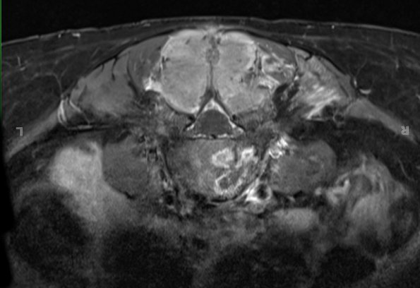 19A3 Ependymoma, anaplastic, metastatic WHO III (Case 19) T1 W 3 - Copy - Copy - Copy