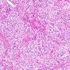 19B1 Ependymoma, anaplastic, metastatic WHO III (Case 19) H&E 6.jpg