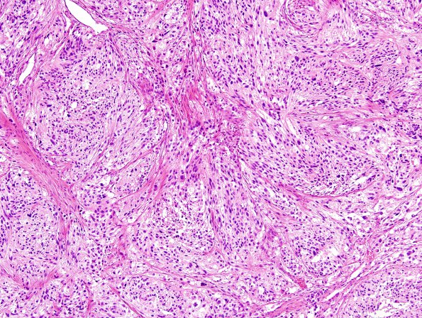 19B1 Ependymoma, anaplastic, metastatic WHO III (Case 19) H&E 6.jpg