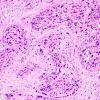 19B2 Ependymoma, anaplastic, metastatic WHO III (Case 19) H&E 9.jpg