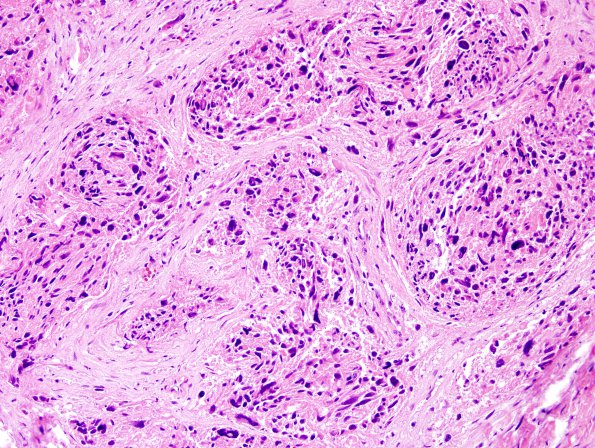 19B2 Ependymoma, anaplastic, metastatic WHO III (Case 19) H&E 9.jpg