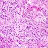 19B3 Ependymoma, anaplastic, metastatic WHO III (Case 19) H&E 1.jpg