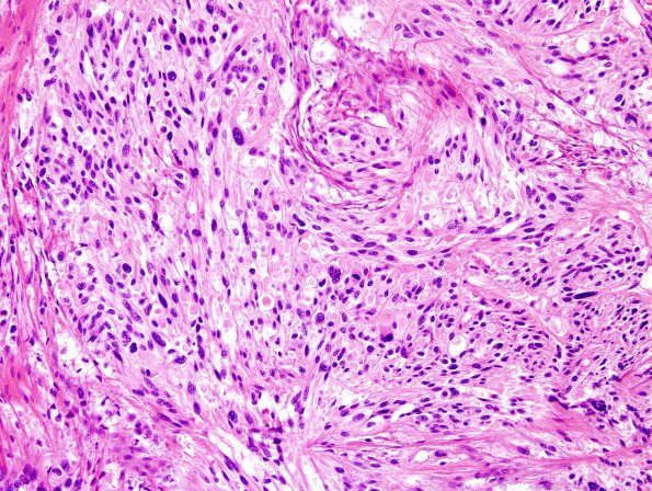 19B3 Ependymoma, anaplastic, metastatic WHO III (Case 19) H&E 1.jpg