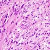 19B5 Ependymoma, anaplastic, metastatic WHO III (Case 19) H&E 5.jpg