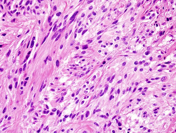 19B5 Ependymoma, anaplastic, metastatic WHO III (Case 19) H&E 5.jpg