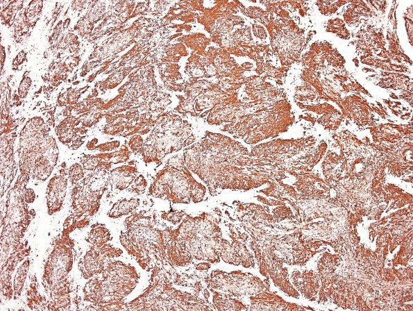 19C Ependymoma, anaplastic, metastatic WHO III (Case 19) GFAP 6.jpg