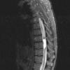 1A1 Ependymoma (Case 1) STIR no contrast - Copy