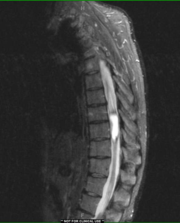 1A1 Ependymoma (Case 1) STIR no contrast - Copy