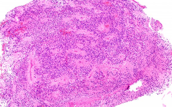 1B1 Ependymoma (Case 1) H&E 2