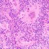 1B2 Ependymoma (Case 1) H&E 5