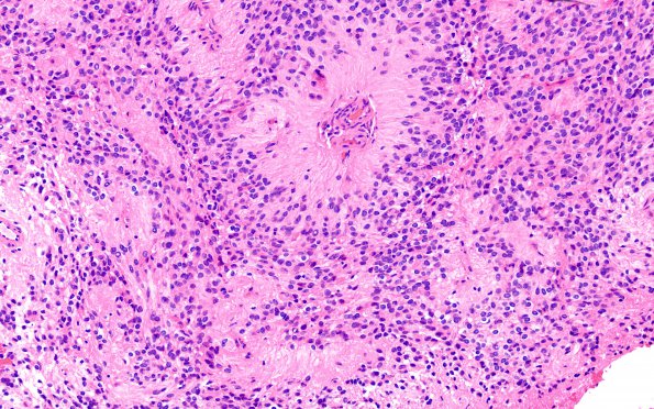 1B2 Ependymoma (Case 1) H&E 5