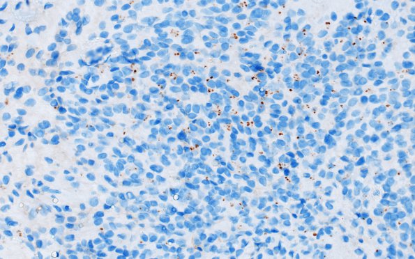 1D Ependymoma (Case 1) D2-40 40X