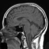 20A2 Ependymoma, syrinx (Case 20) T1 A - Copy