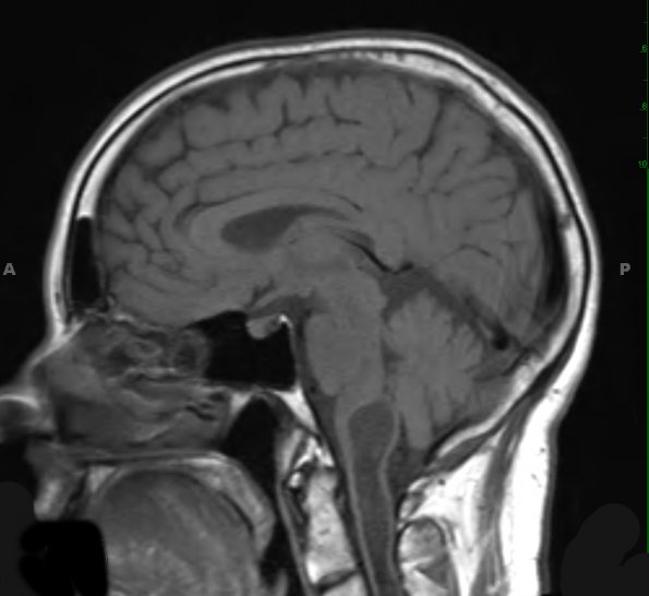 20A2 Ependymoma, syrinx (Case 20) T1 A - Copy