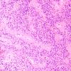 20B Ependymoma (Case 20) H&E