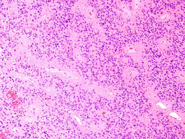 20B Ependymoma (Case 20) H&E