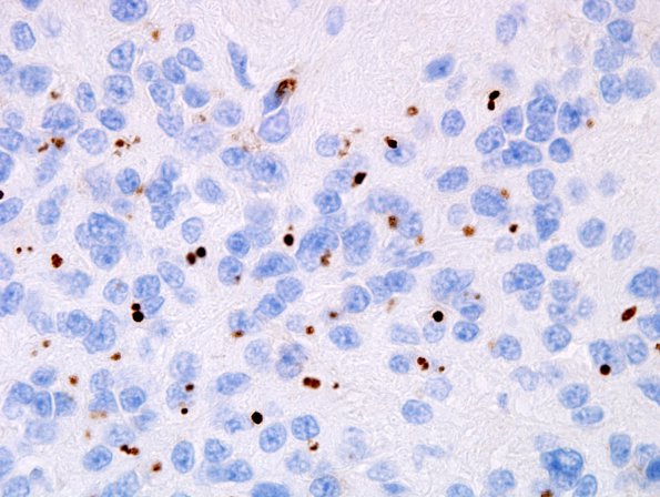 20D Ependymoma (Case 20) EMA 1