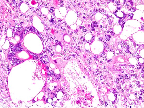 21A1 Ependymoma, giant cell (Case 21) H&E 2.jpg