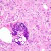 21A2 Ependymoma, giant cell (Case 21) H&E 1.jpg